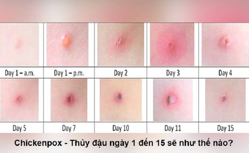 20200220_benh-thuy-dau(2)